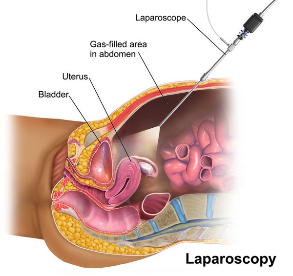 Подготовка к лапароскопии кисты яичника минск thumbnail